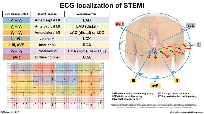 The image provides a guide to ECG localization of STEMI, illustrating affected leads, infarct locations, and associated coronary vessels, along with anatomical placement on a human figure. (Captioned by AI)