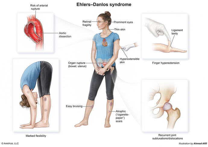 Ehlers danlos syndrome