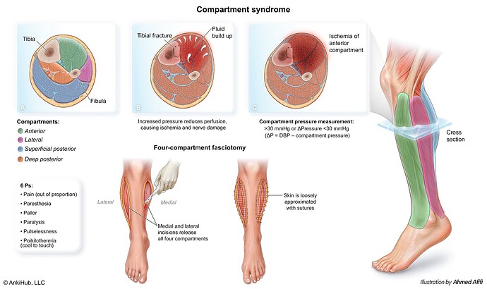 Compartment syndrome comp