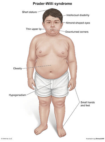 Prader_Willi_Syndrome