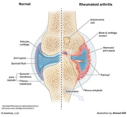 Rheumatoid arthritis