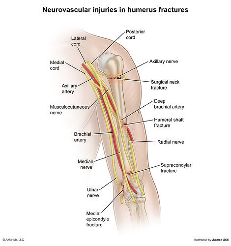 Neurovascular Injuries in Humerus Fractures