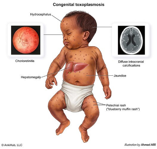 Congenital toxoplasmosis comp
