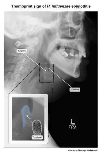 ThumbprintEpiglottitis