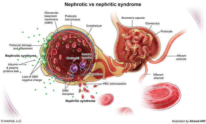 Nephritic vs nephrotic syndrome illustration