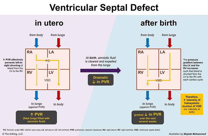 vsd