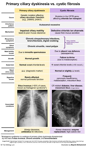 The image is a comparative chart detailing the differences between primary ciliary dyskinesia and cystic fibrosis, covering aspects like causes, symptoms, and management. (Captioned by AI)