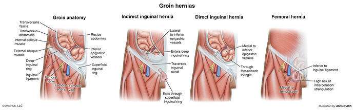 Groin_hernias