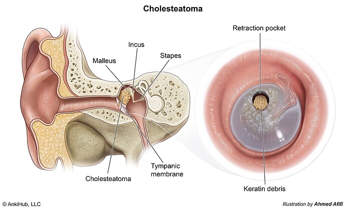 Cholesteatoma