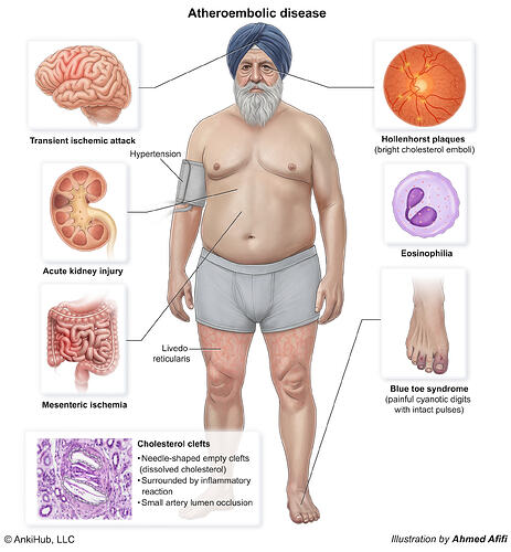 Atheroembolic disease