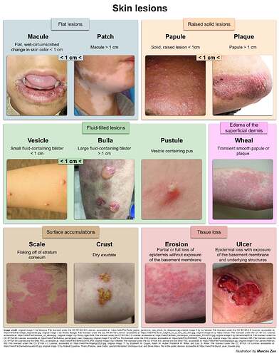 Skin lesions copy