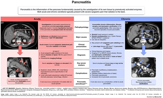 Acute and chronic pancreatitis by Marcos Zan (1) copy