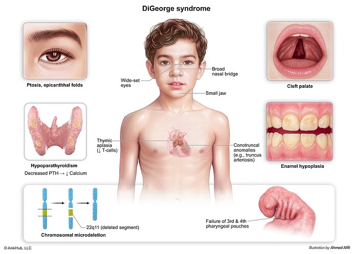 Di George syndrome - comp copy