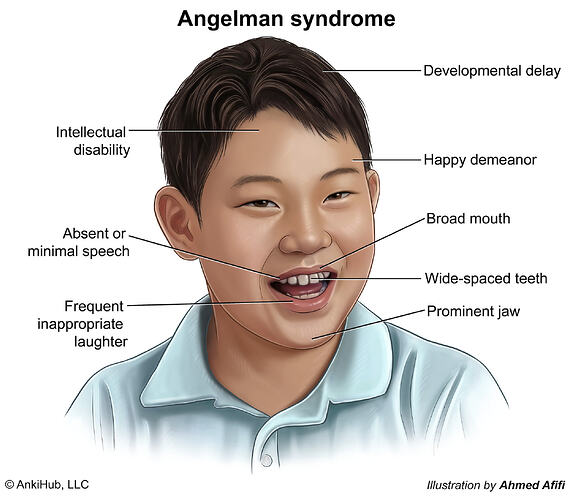 Angelman syndrome