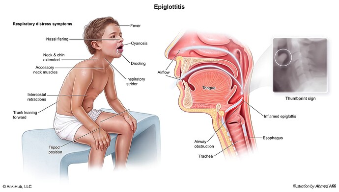 Epiglottitis & croup comp copy