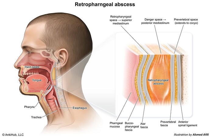 Retropharyngeal abscess