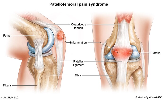 Patellofemoral pain syndrome - comp copy