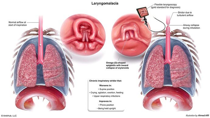 Laryngomalacia Comp