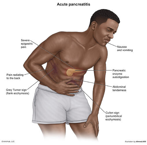 Acute_Pancreatitis