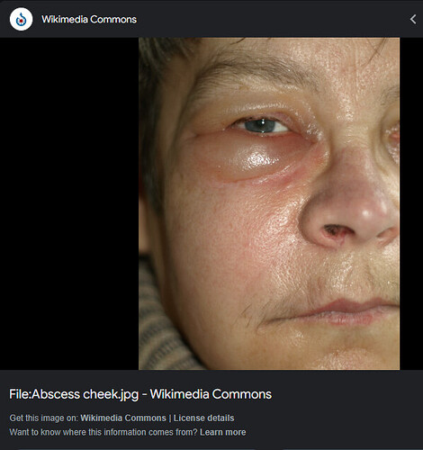 A close-up image shows a person's swollen cheek and eye area with visible inflammation. (Captioned by AI)
